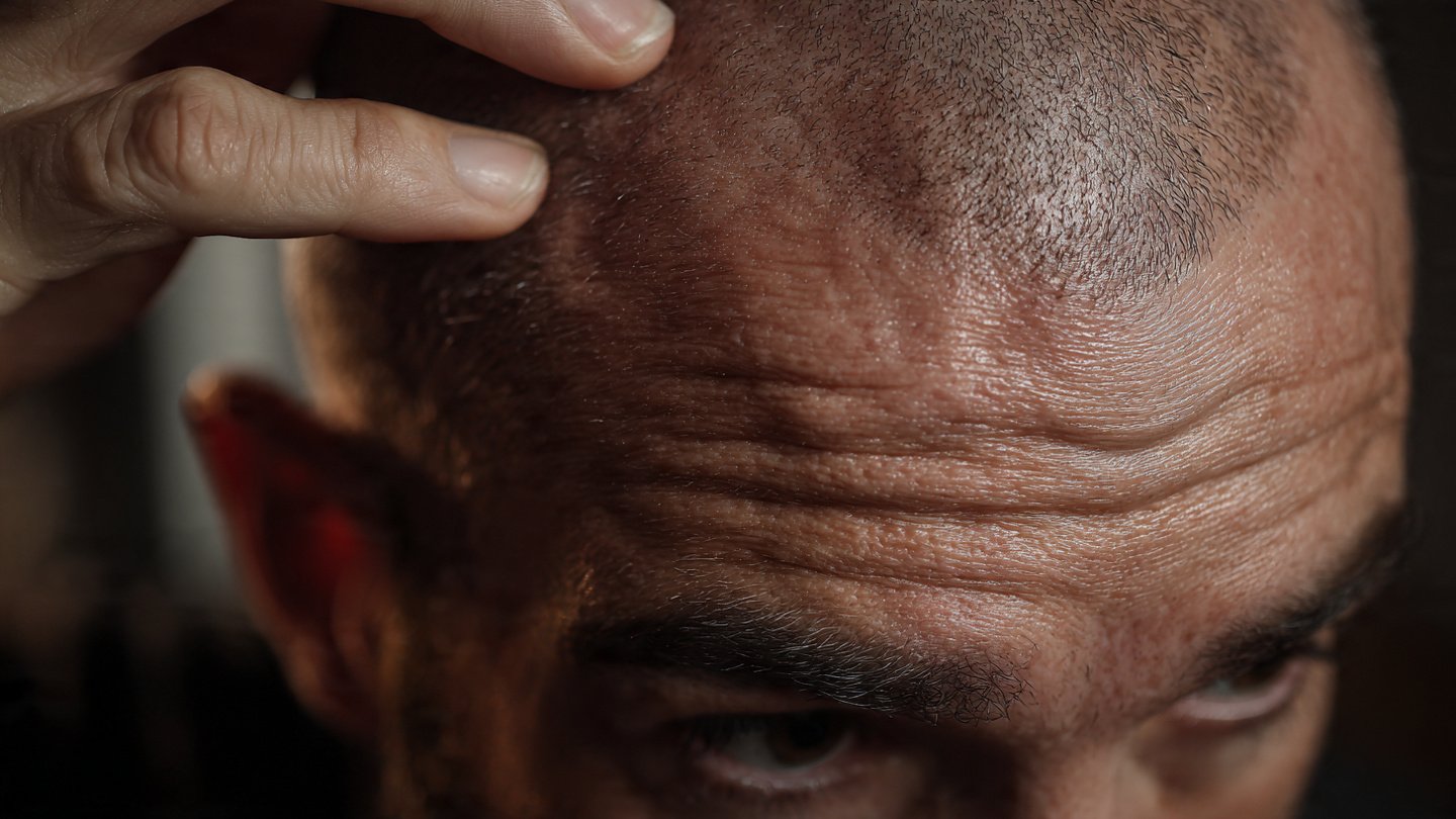 hair_loss_treatments