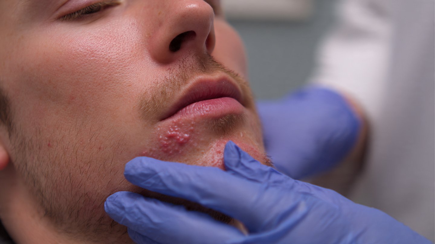 lumps_bumps_treatment
