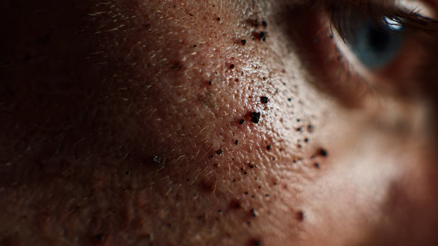 moles_warts_treatment