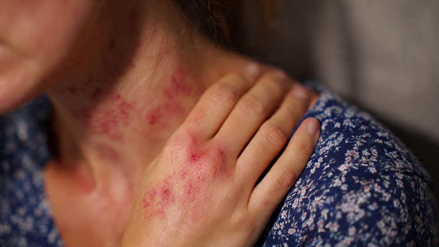 rashes_skin_infection